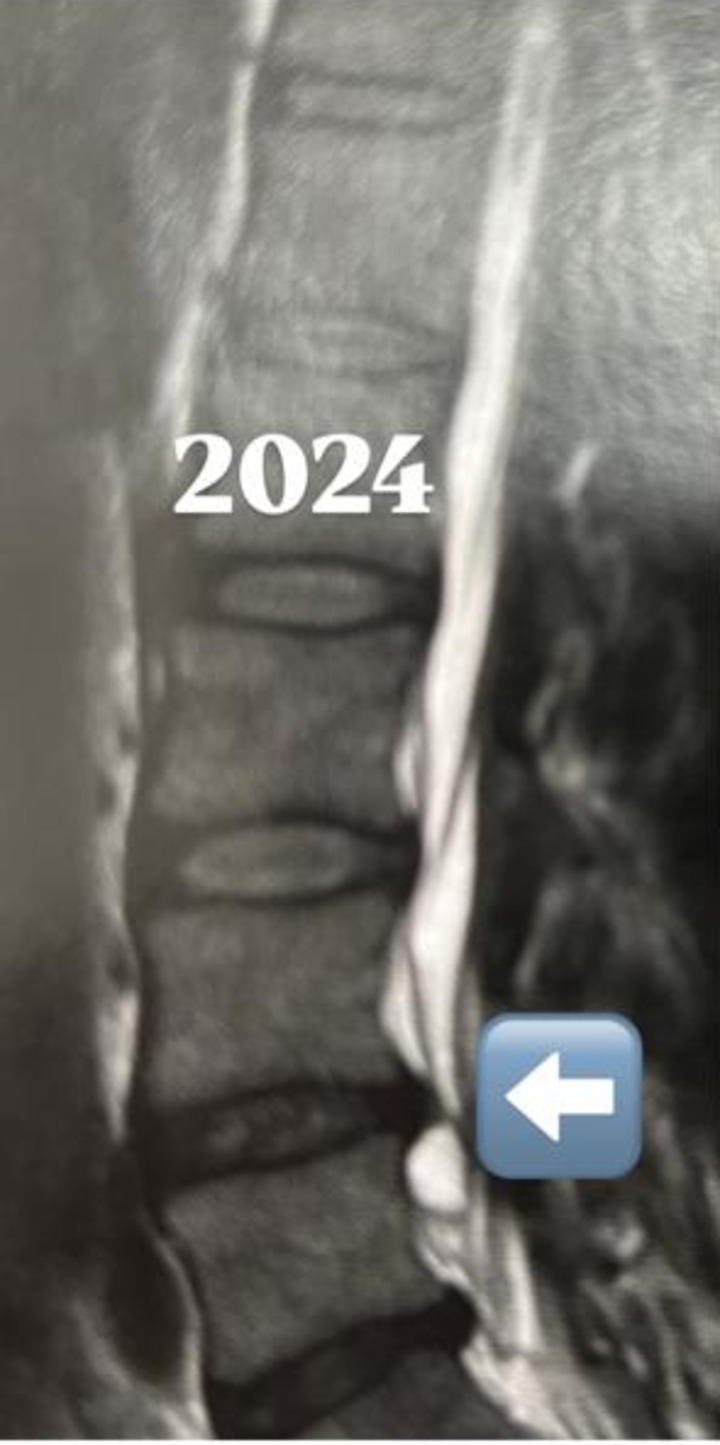 Ressonância magnética da coluna lombar em 2024, no início do acompanhamento.